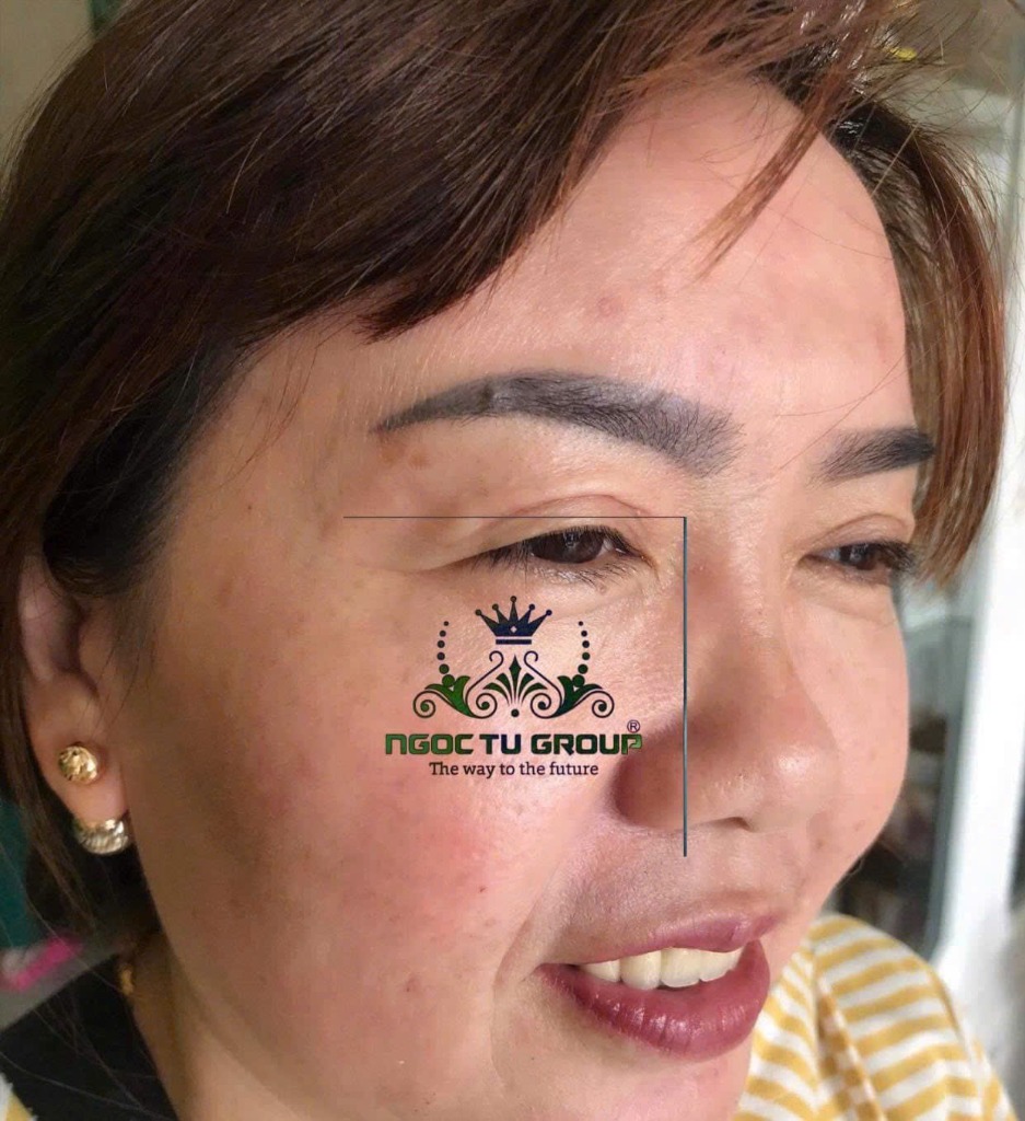 Sau khi dùng MELAS - Da sáng mịn đều màu