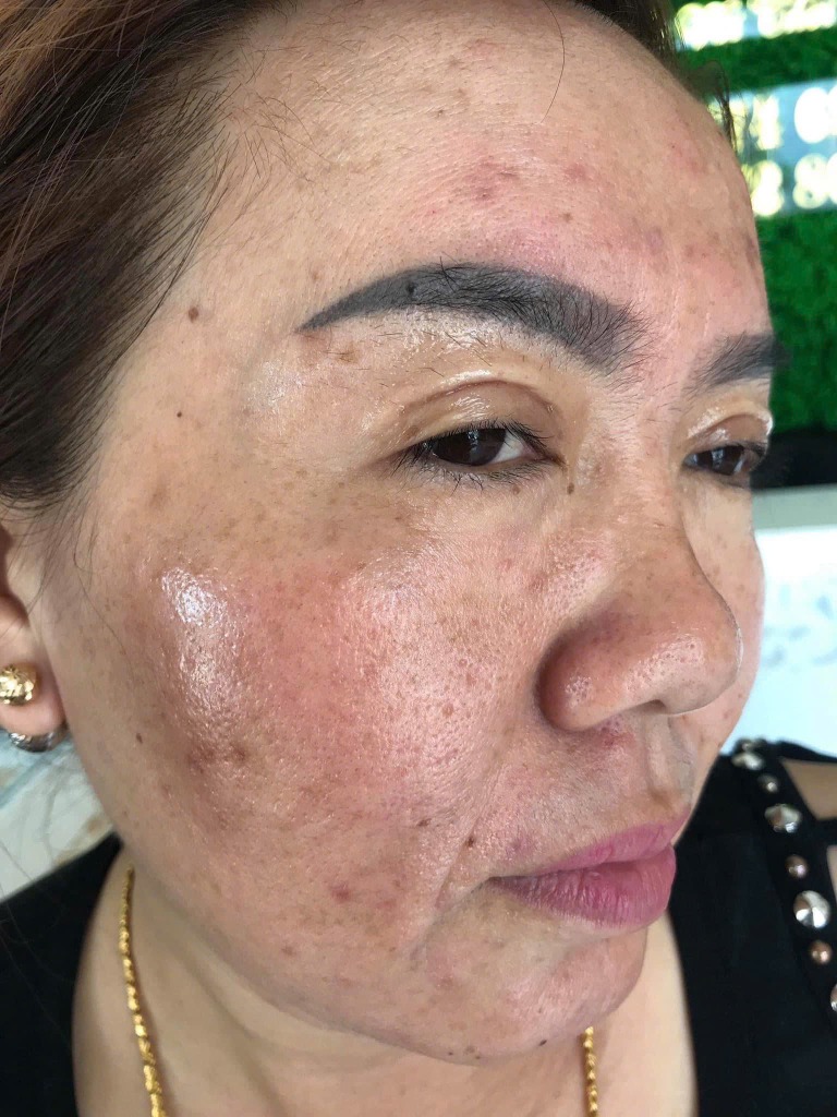 Trước khi dùng MELAS - Da bị nám sạm nặng