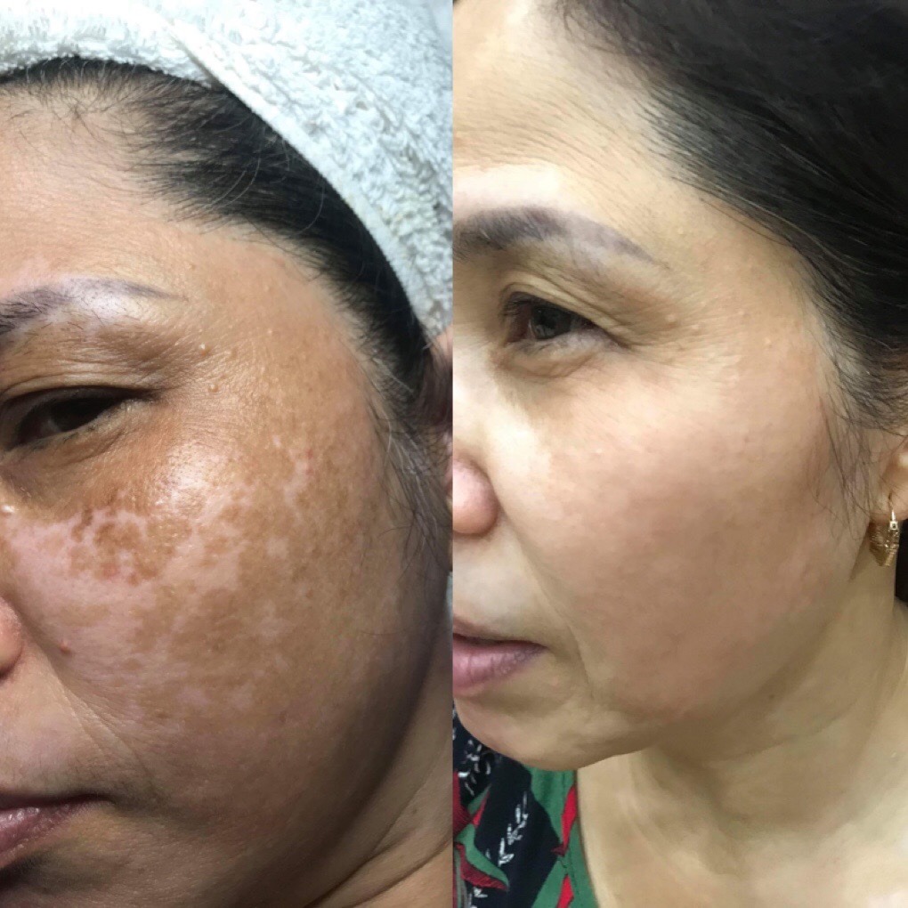 Kết quả trị nám - Trước và sau khi dùng MELAS