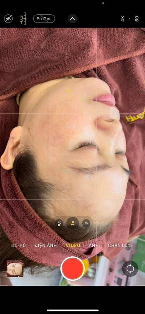 Khách hàng spa sau liệu trình trị nám MELAS