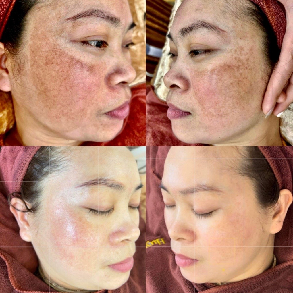 Quá trình trị nám qua 4 giai đoạn với MELAS