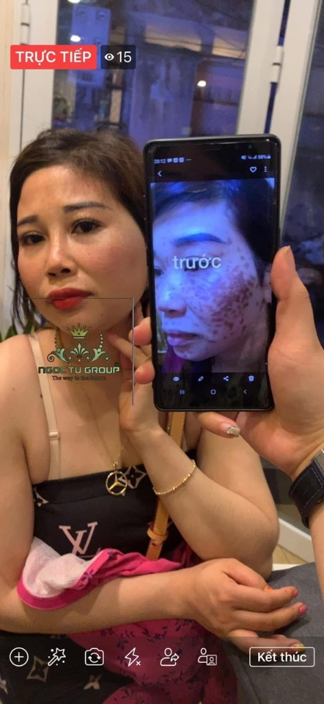 Khách hàng livestream khoe kết quả trị nám MELAS — trước và sau