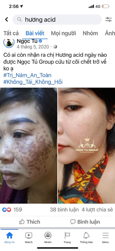 Bài đăng Facebook viral - Chị Hương acid trước và sau trị nám với MELAS